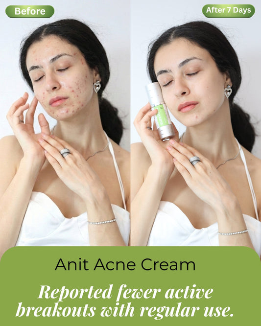 Anti Acne Cream Elevation Beauty