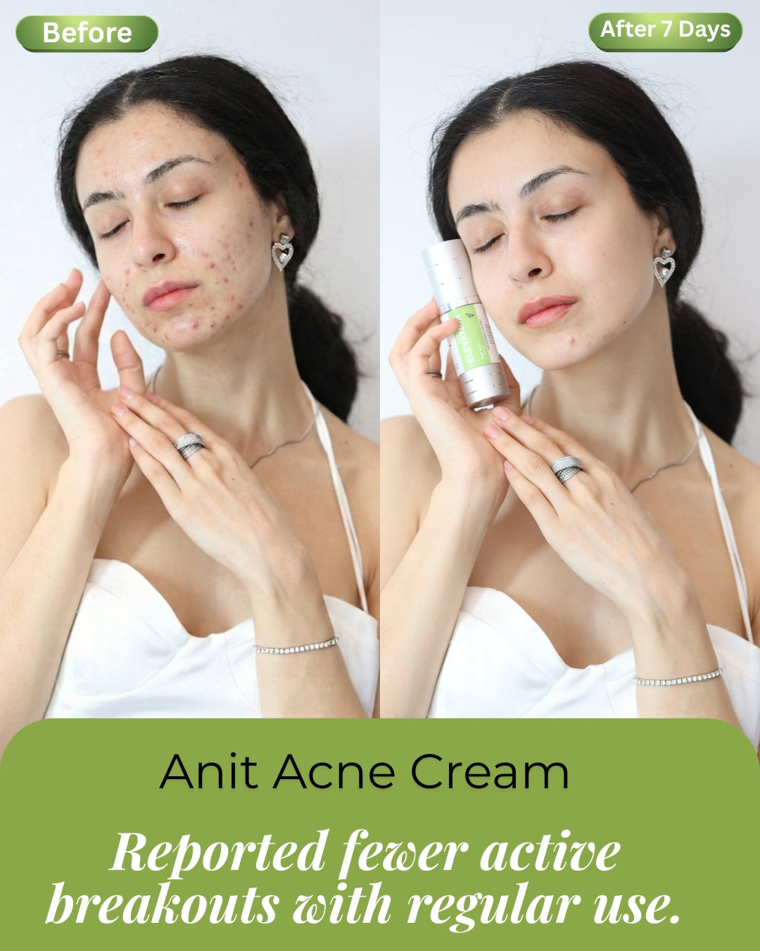 Anti Acne Cream Elevation Beauty