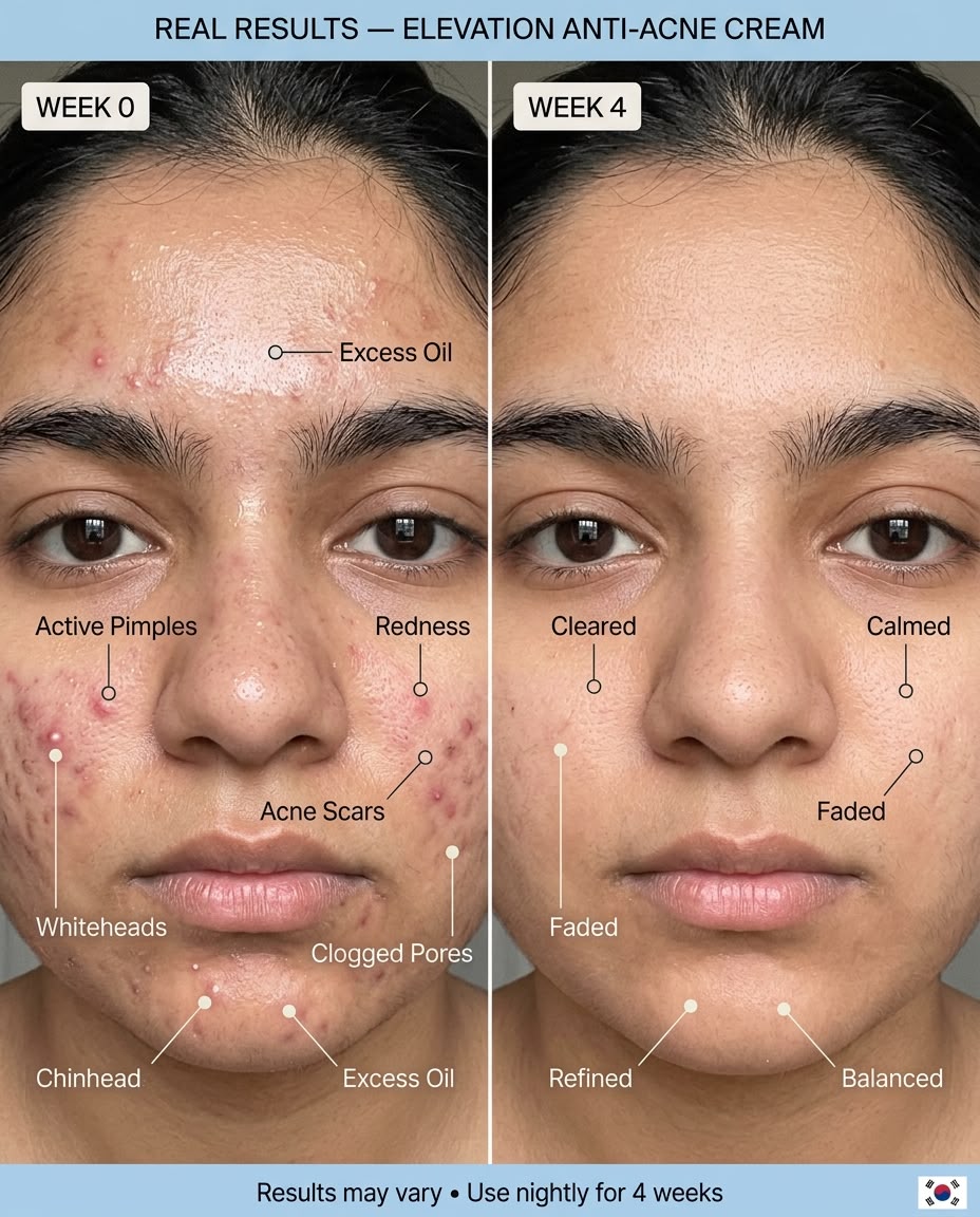 Anti Acne Bundle Elevation Beauty