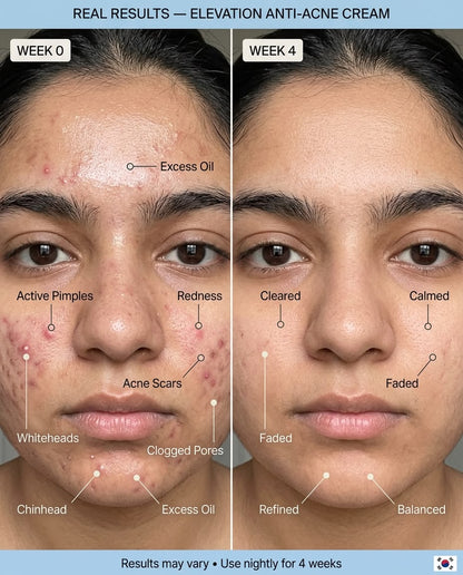 Anti Acne Bundle Elevation Beauty